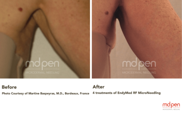 Transform Your Arms and Knees with the Mini Shaper and MDPen Tighten + Lift Serum