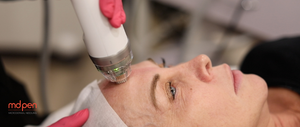 7 Essential Post-Treatment Skincare Tips for Radio Frequency Micro Needling