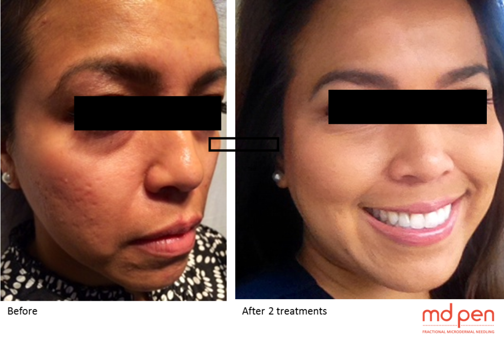 microneedling before and after 4