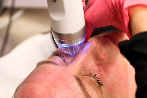 Post-Care Guide for Optimal Results after RF Micro Needling