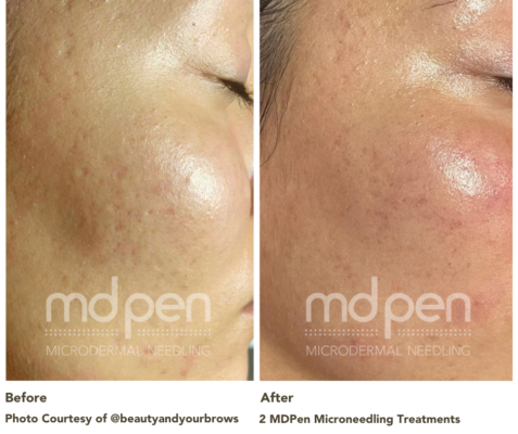 @beautyandyourbrows acne scarring before and after