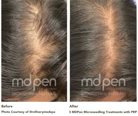 @refinerymedspa hair restoration with PRP before and after