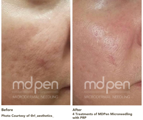@rl_aesthetics_ Before and After Images Acne Scarring and Texture