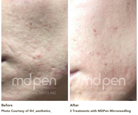 @rl_aesthetics_ Before and After Images Acne Scars and Texture