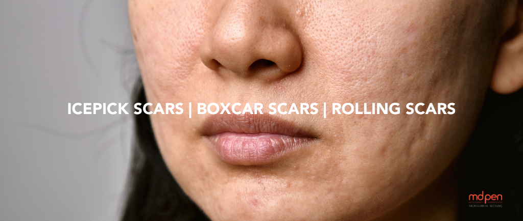 The Three Types of Atrophic Acne Scars and How to Treat Them with Microneedling