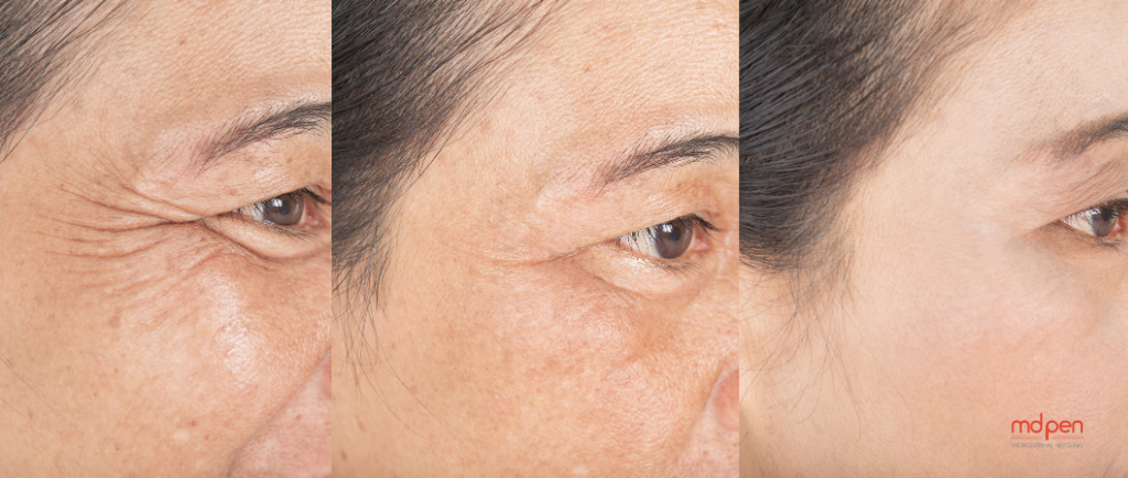Prevent Wrinkles by Taking Proactive Measures Early On