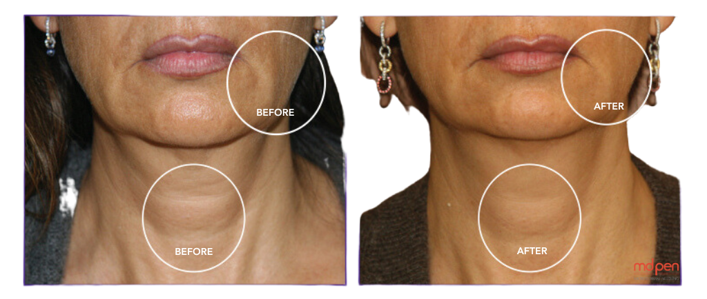 Rejuvenate Your Skin Naturally with ENDYMED’s 3DEEP RF for Non-Invasive Facial Tightening and  Collagen Restoration