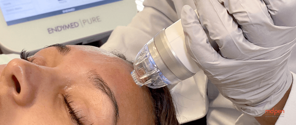 Say Goodbye to Fine Lines: Achieve Smooth Skin with Radio Frequency Microneedling
