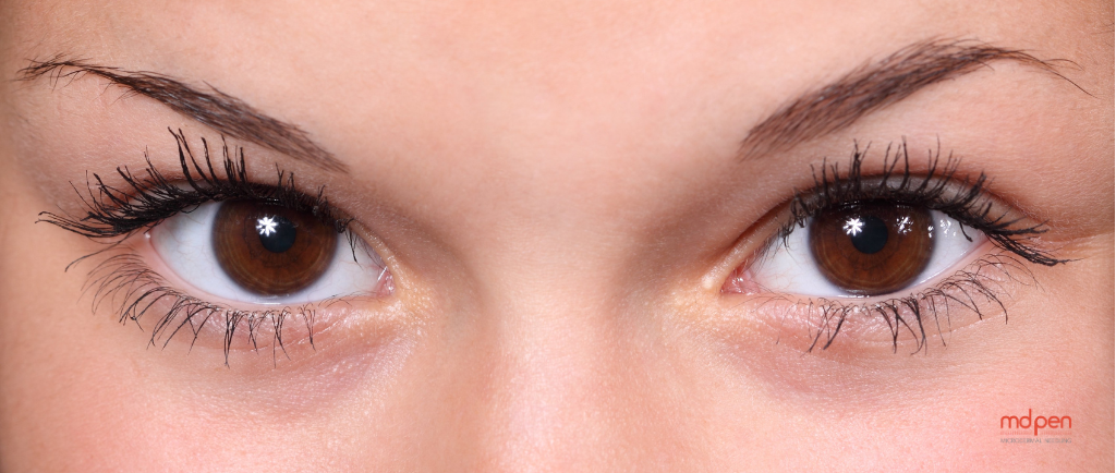 Bye Bye Saggy Eyes: Achieve a Youthful Look with Non-Surgical Eye-Lift using Multi-Source RF