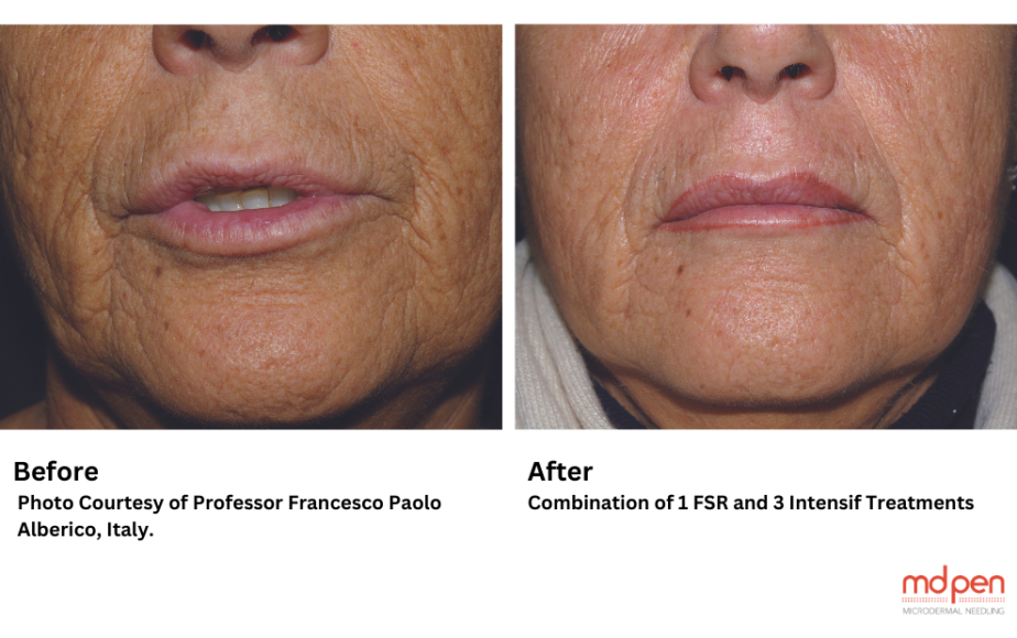Maximizing Results with a Combination of EndyMed RF Microneedling and FSR