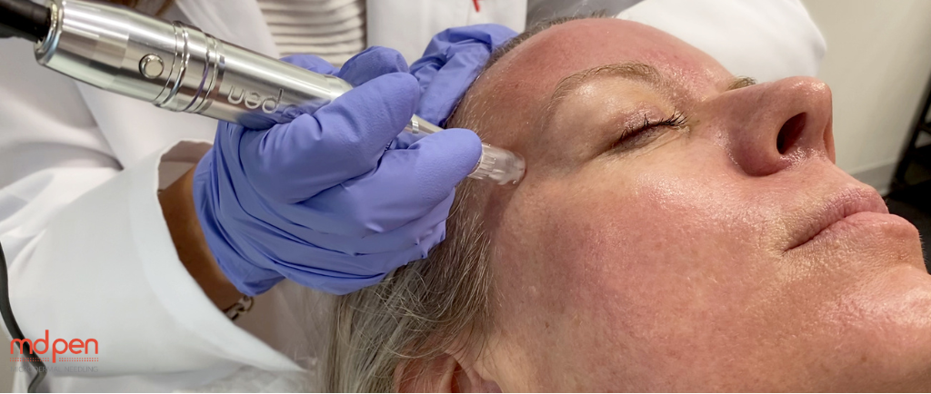 Microneedling Training: Your Guide to Certification and Classes Near You