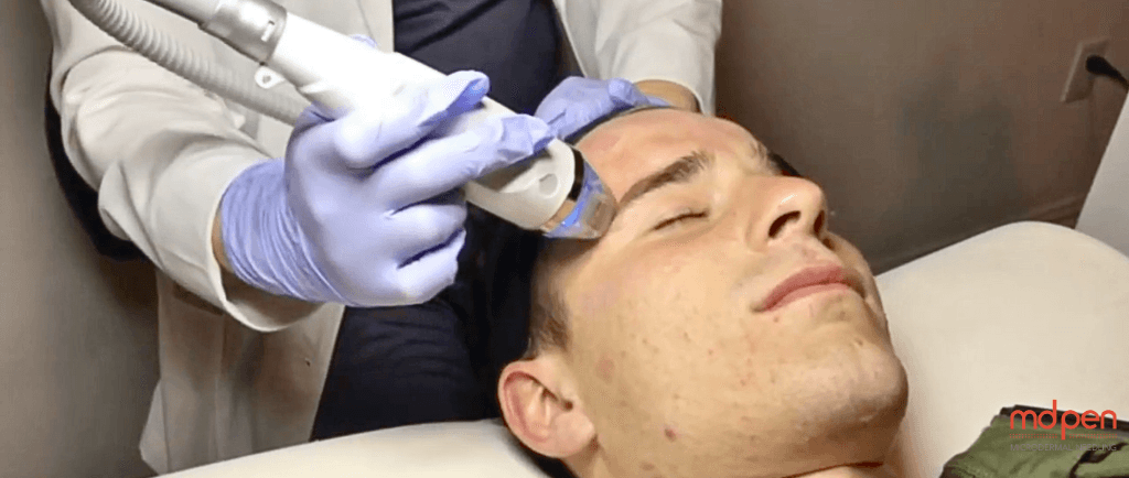 The Ultimate Guide to Post-RF Microneedling Aftercare for Men