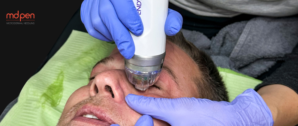 Banishing Scars: How Men Can Fade Stubborn Marks with Radio Frequency Microneedling