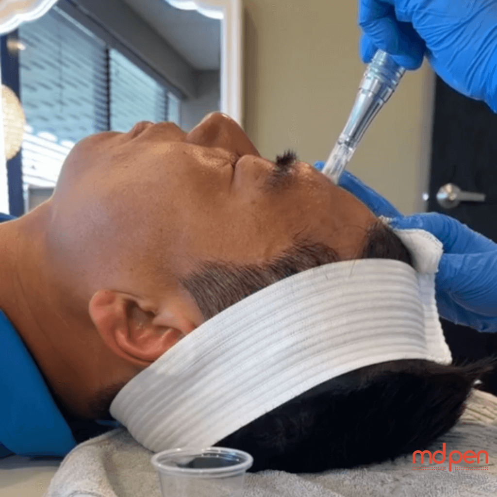 Reclaim Your Confidence: Microneedling and MDPen Serums for Men’s Sexy Transformation