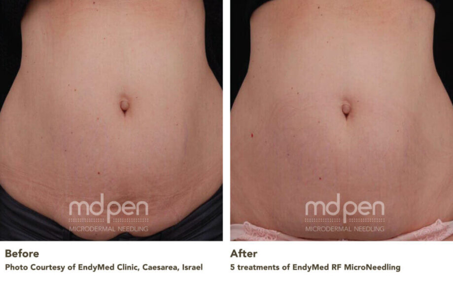 Post-Care Guide for Optimal Results after Radio Frequency Micro Needling with EndyMed Intensif and  MDPen Serums