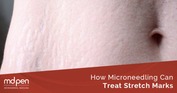 How MicroNeedling Can Treat Stretch Marks