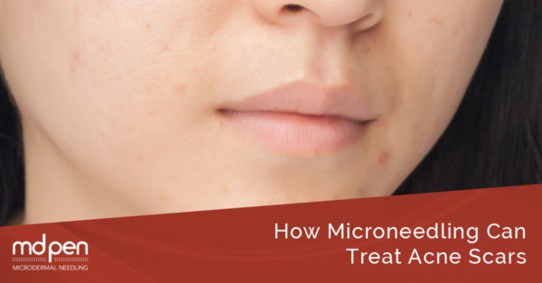 How microneedling Can Treat Acne Scars