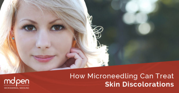 How microneedling Can Treat Skin Discolorations