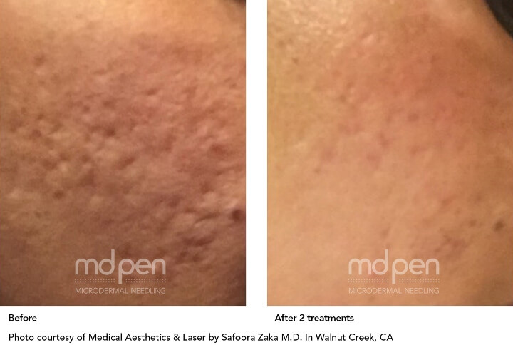 The Three Types of Atrophic Acne Scars and How to Treat Them with Microneedling