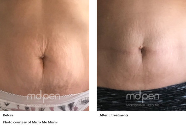 MDPen_BeforeAfter_011419_tummy