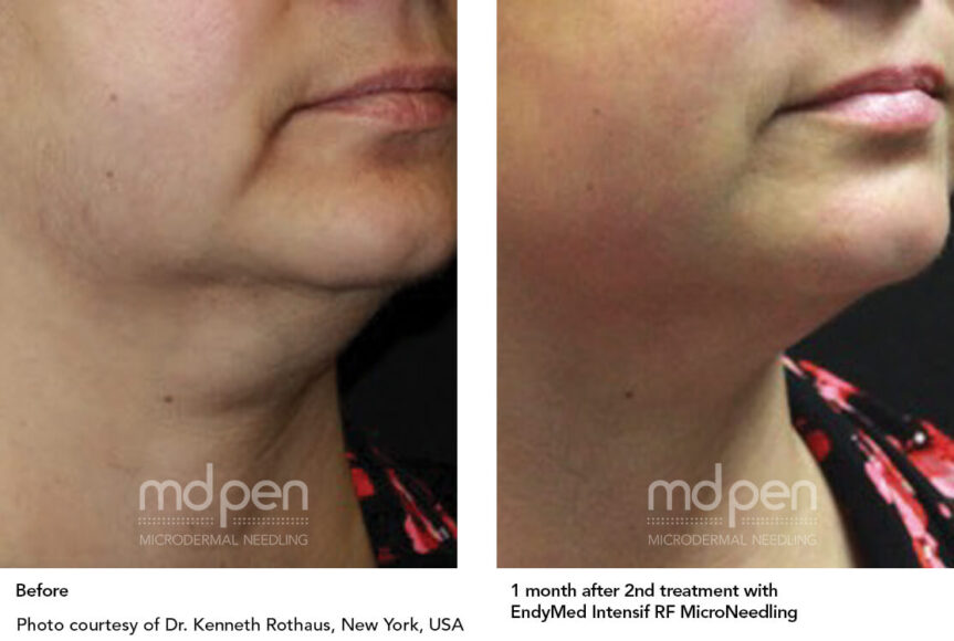 Revitalize Your Skin with RF Micro Needling: Tips for a Speedy Recovery and Optimal Results