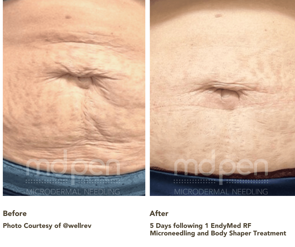 Say Farewell to Stretch Marks! Try RF Microneedling and Embrace Clear Skin