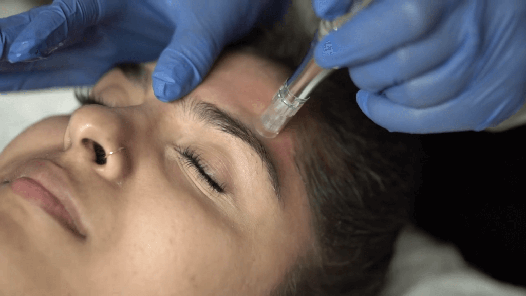 The Complementary Nature of MicroNeedling and Acupuncture